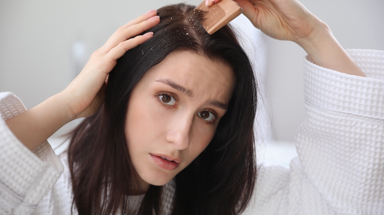 does dandruff cause hair loss