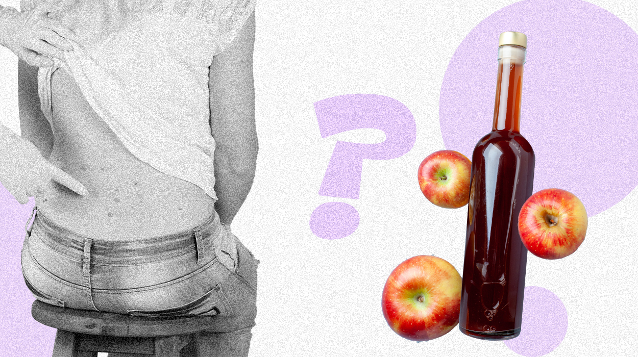apple cider vinegar for skin tags