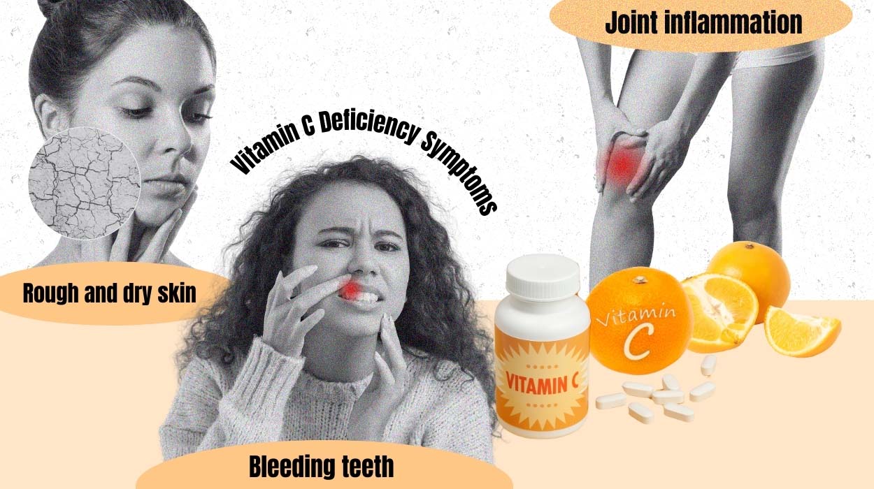 vitamin c deficiency symptoms